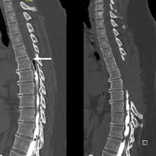 CT Myelogram