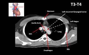 CT Scan Chest