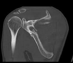 CT Scapula