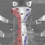 CT Scan of the sternum