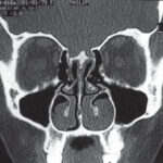 HRCT PNS Scan