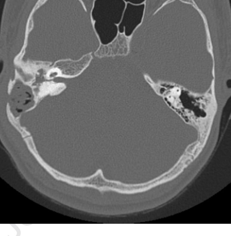 HRCT Temporal Bone Axial