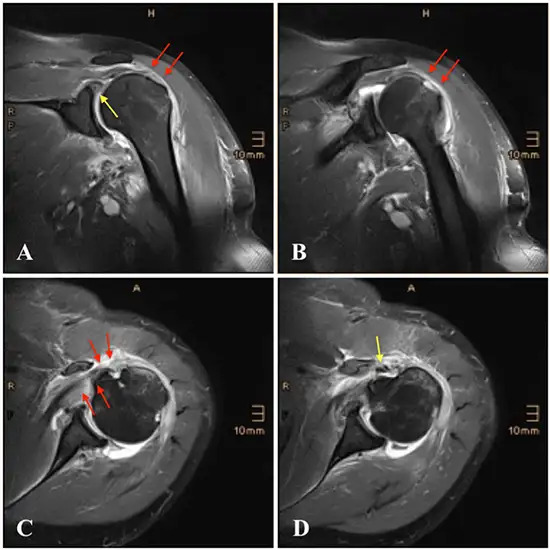 MRI Screening for Left Shoulder