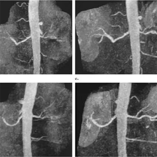 MR Angiography Abdominal Aorta With Contrast