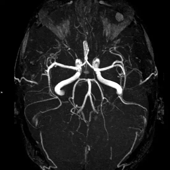 MR Angiography Brain T2W