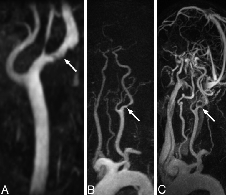MR Angiography Carotid