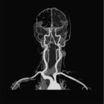 MR Angiography (MRA) of the Brain