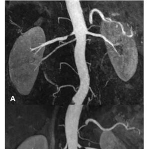 MR Angiography of Renal Vessels | Accurate Imaging | Medintu