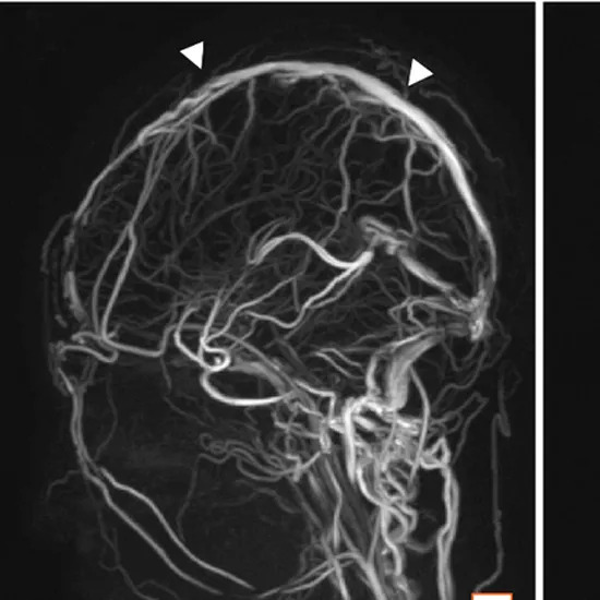 MR Venography Brain With Contrast