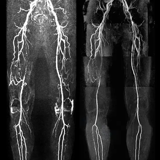MR Venography Left Lower Limb With Contrast