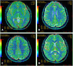 MRI Brain Perfusion