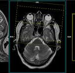 MRI Cisternography Head