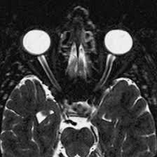 MRI-Eye