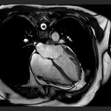 MRI Heart