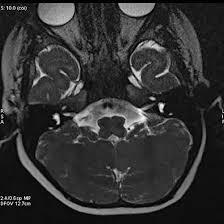 MRI Internal EAR