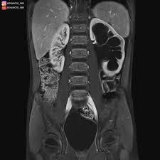 MRI-Kidneys