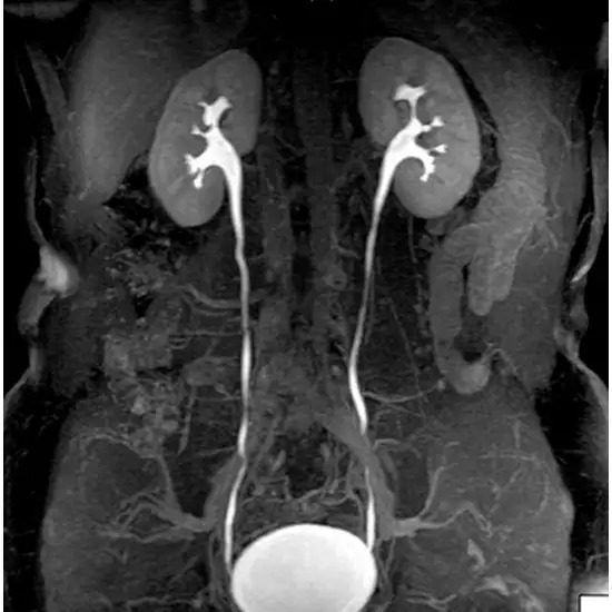 MRI-Kub-With-Contrast