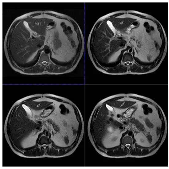 MRI Liver Scan