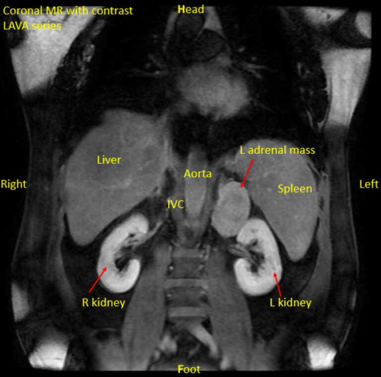 MRI-Lower-Abdomen-With-Contrast