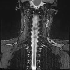 MRI Myelography