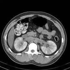 MRI Nephrogram Scan