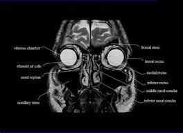 MRI PNS