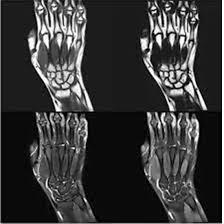 MRI-Right-Hand-With-Contrast