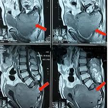 MRI Sacrum Scan