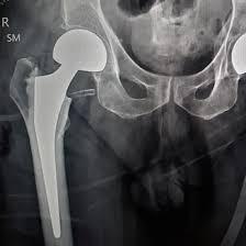 MRI-Screening-Of-Right-Hip