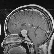 MRI Sella With Contrast