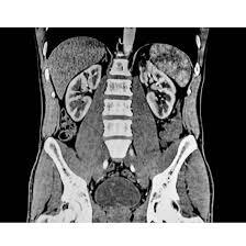 MRI Upper Abdomen