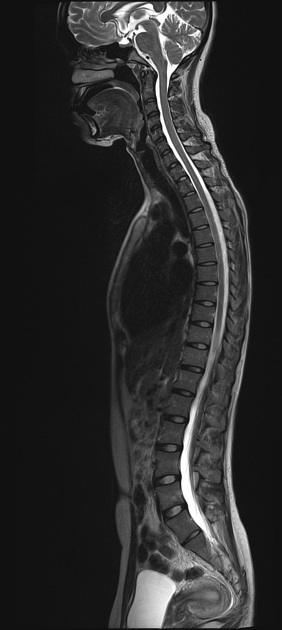 MRI Whole Spine
