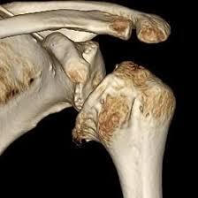 NCCT 3D Right Shoulder