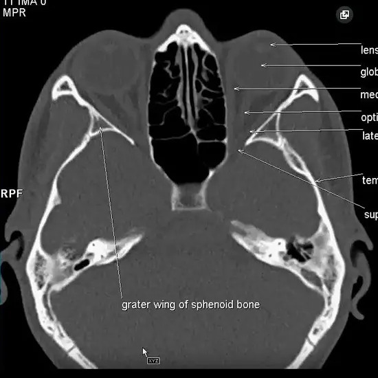 NCCT PNS Axial