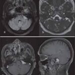 MRI Brain With C P Angle With Contrast​