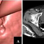 CT Colonoscopy