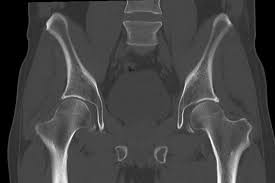 CT Hip Joints