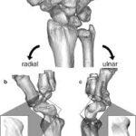 CT 3D Right Scaphoid