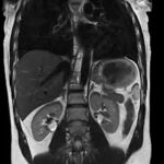 MRI Whole Abdomen With Contrast