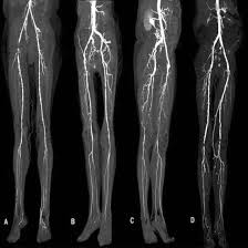 CT Peripheral Angiography