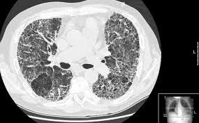 HRCT Thorax