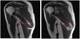 MRI Right Scapula