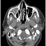NCCT PNS Axial/Coronal Scan