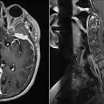 MRI Brain With Cervical Spine