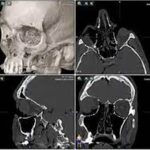 CT Orbit Axial/Coronal 3D