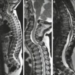 MRI Screening of Cervical Spine