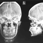 CT PNS and Neck