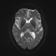 MRI Brain + DWI (Diffusion Weighted Imaging)