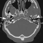 CECT Face and Neck