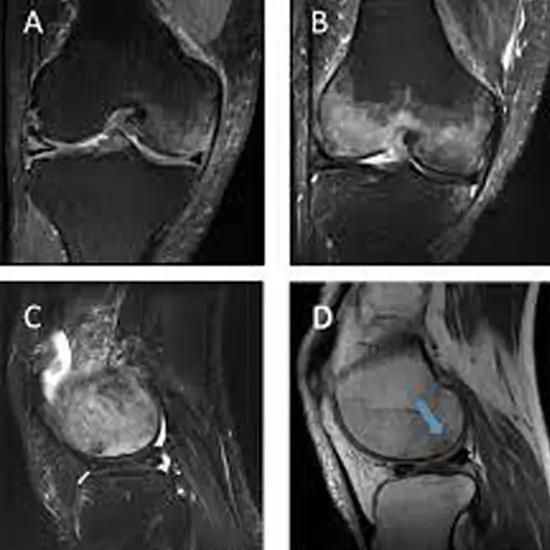 MRI B&L Knee Contrast